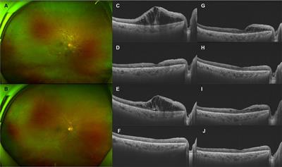 Central retinal vein occlusion in patients with metastatic solid tumors on tyrosine kinase inhibitors: a report of case series and literature review